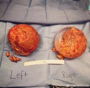 刘成胜告诉你假体隆胸后多久会出现包膜挛缩？