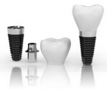 德国费亚丹种植牙系统