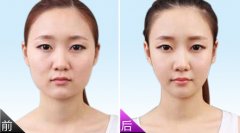 巴中依韩做吸脂瘦脸手术是否会反弹