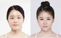 巴中依韩玻尿酸注射丰苹果肌能保持多长时间