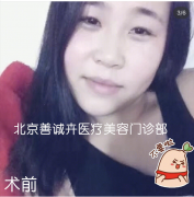 北京善诚卉张维娜院长SCH克隆骨隆鼻案例，天生超低鼻梁大逆袭