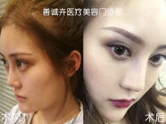 隆鼻大学问千万不要盲目选择—善诚卉张维娜SCH克隆骨隆鼻